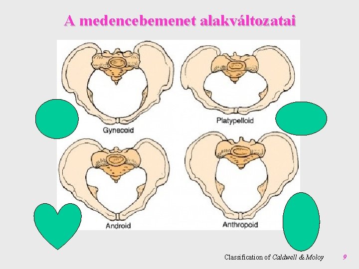 A medencebemenet alakváltozatai Classification of Caldwell & Moloy 9 