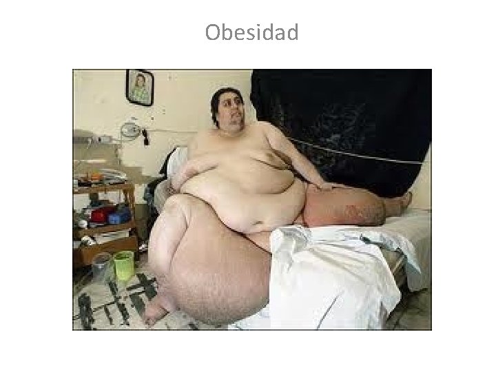 Obesidad 