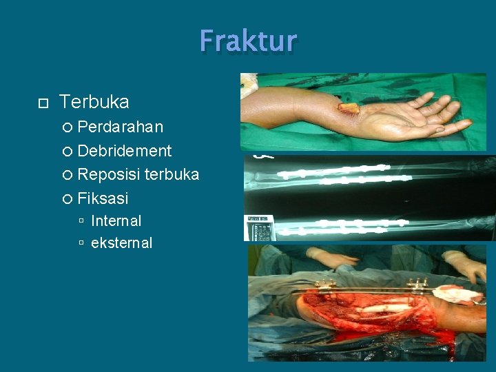 Fraktur Terbuka Perdarahan Debridement Reposisi terbuka Fiksasi Internal eksternal 