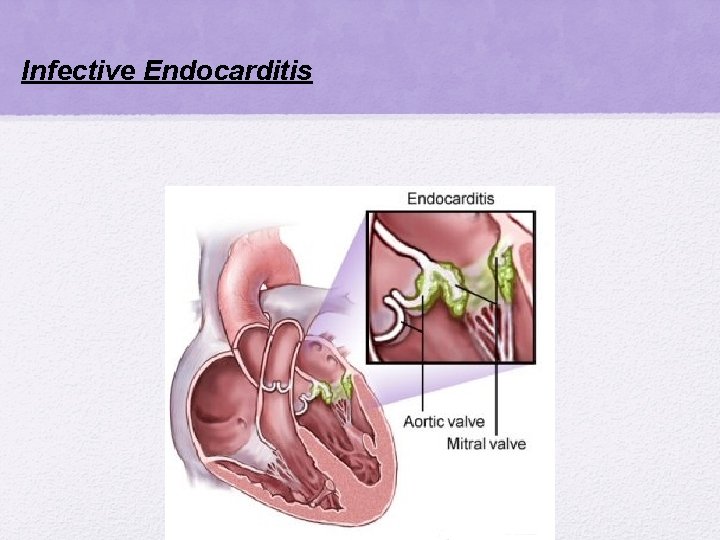 Infective Endocarditis Infective Endocarditis