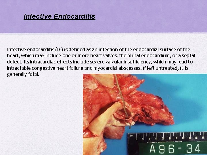 Infective Endocarditis Infective endocarditis (IE) is defined as an infection of the endocardial surface Infective Endocarditis Infective endocarditis (IE) is defined as an infection of the endocardial surface
