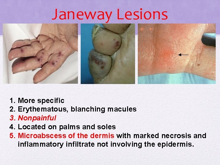 Janeway Lesions 1. More specific 2. Erythematous, blanching macules 3. Nonpainful 4. Located on Janeway Lesions 1. More specific 2. Erythematous, blanching macules 3. Nonpainful 4. Located on
