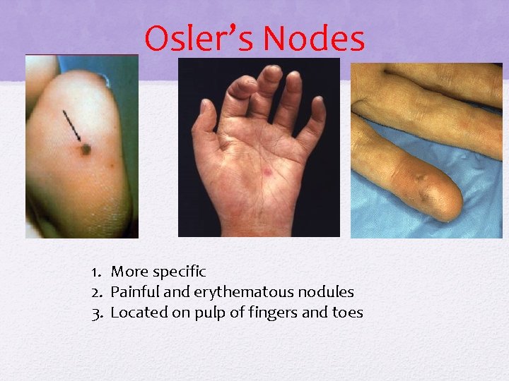 Osler’s Nodes 1. More specific 2. Painful and erythematous nodules 3. Located on pulp Osler’s Nodes 1. More specific 2. Painful and erythematous nodules 3. Located on pulp