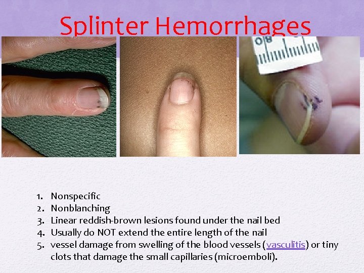 Splinter Hemorrhages 1. 2. 3. 4. 5. Nonspecific Nonblanching Linear reddish-brown lesions found under Splinter Hemorrhages 1. 2. 3. 4. 5. Nonspecific Nonblanching Linear reddish-brown lesions found under