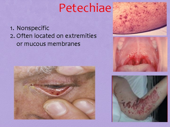 Petechiae 1. Nonspecific 2. Often located on extremities or mucous membranes Petechiae 1. Nonspecific 2. Often located on extremities or mucous membranes