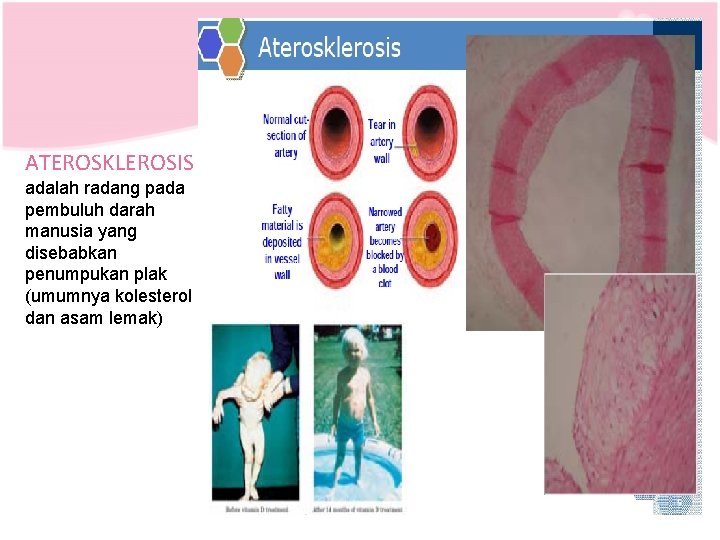 ATEROSKLEROSIS adalah radang pada pembuluh darah manusia yang disebabkan penumpukan plak (umumnya kolesterol dan