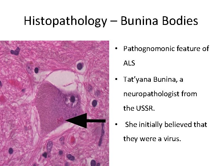 Histopathology – Bunina Bodies • Pathognomonic feature of ALS • Tat’yana Bunina, a neuropathologist