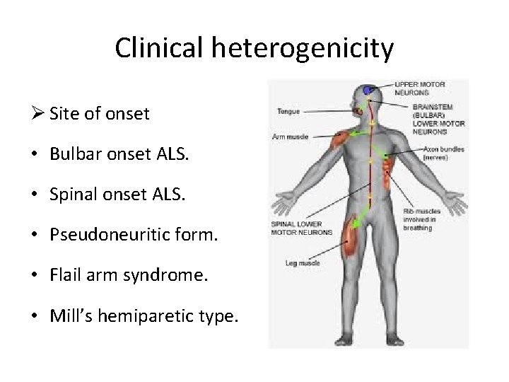 Clinical heterogenicity Ø Site of onset • Bulbar onset ALS. • Spinal onset ALS.