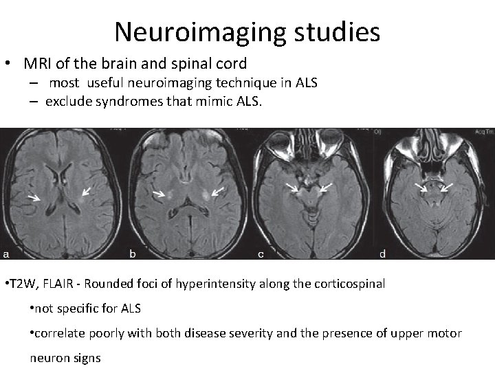 Neuroimaging studies • MRI of the brain and spinal cord – most useful neuroimaging