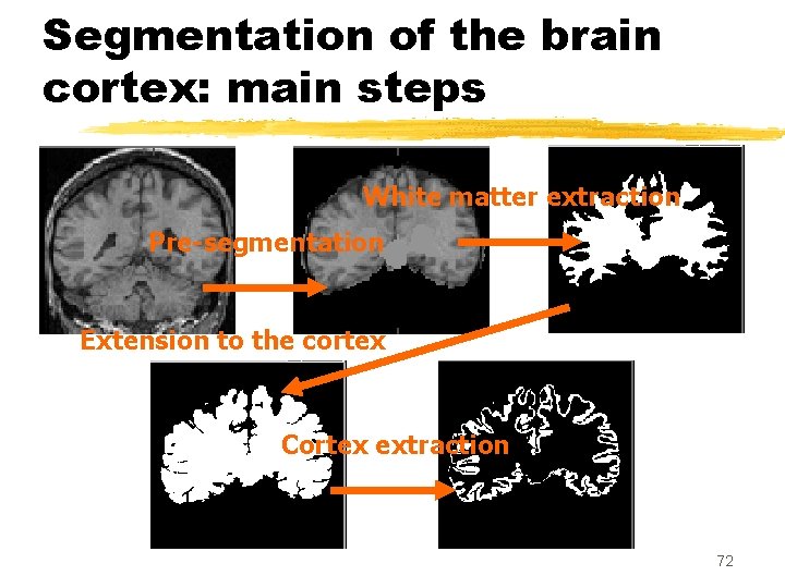 Segmentation of the brain cortex: main steps White matter extraction Pre-segmentation Extension to the