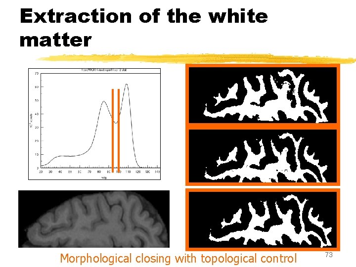 Extraction of the white matter Morphological closing with topological control 73 