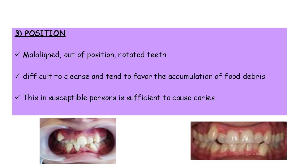 3) POSITION ü Malaligned, out of position, rotated teeth ü difficult to cleanse and