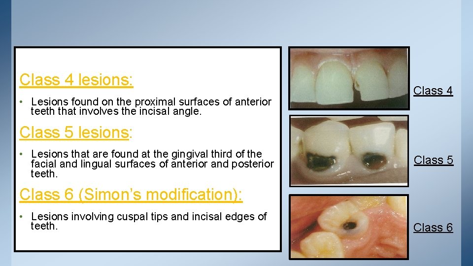 Class 4 lesions: • Lesions found on the proximal surfaces of anterior teeth that