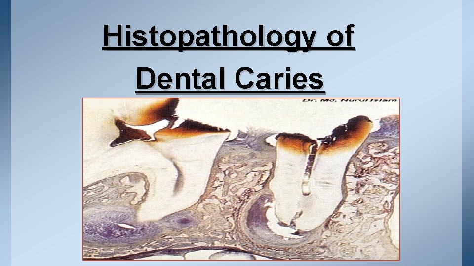 Histopathology of Dental Caries 