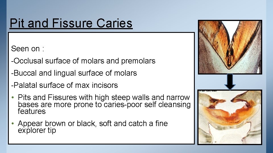 Pit and Fissure Caries Seen on : -Occlusal surface of molars and premolars -Buccal