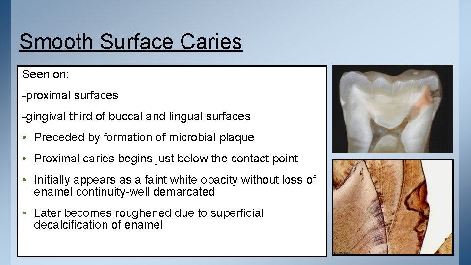 Smooth Surface Caries Seen on: -proximal surfaces -gingival third of buccal and lingual surfaces