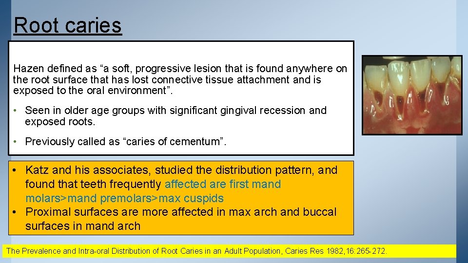 Root caries Hazen defined as “a soft, progressive lesion that is found anywhere on