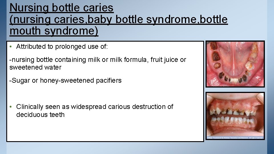 Nursing bottle caries (nursing caries, baby bottle syndrome, bottle mouth syndrome) • Attributed to