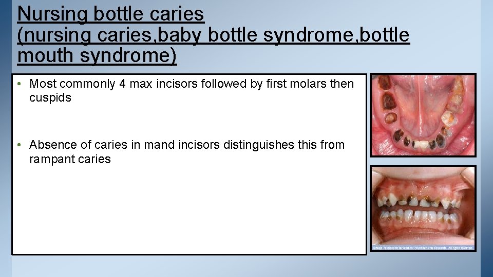 Nursing bottle caries (nursing caries, baby bottle syndrome, bottle mouth syndrome) • Most commonly