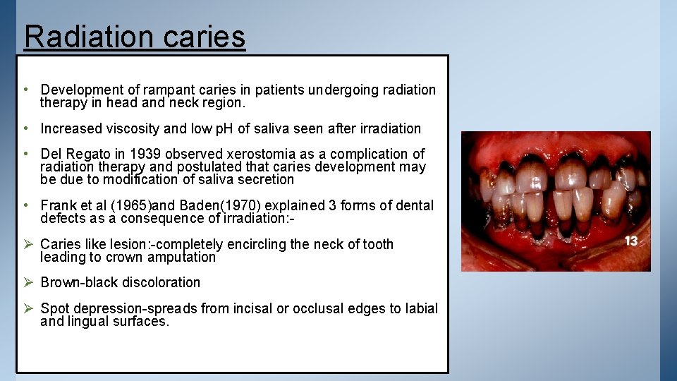 Radiation caries • Development of rampant caries in patients undergoing radiation therapy in head