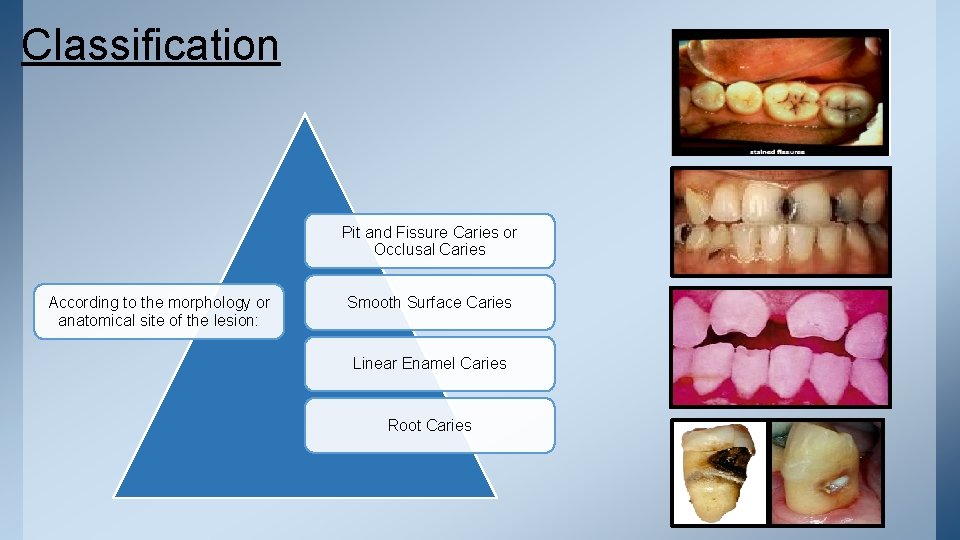 Classification Pit and Fissure Caries or Occlusal Caries According to the morphology or anatomical