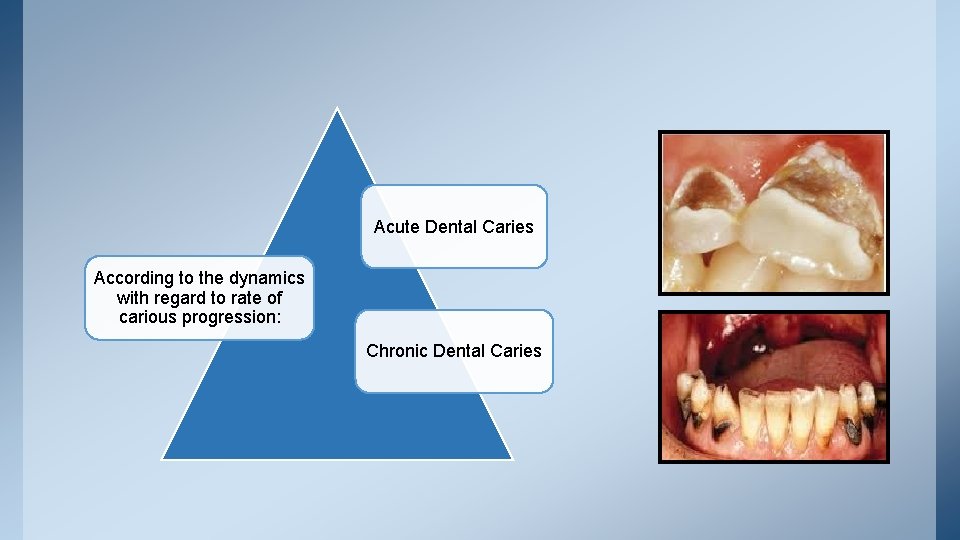 Acute Dental Caries According to the dynamics with regard to rate of carious progression: