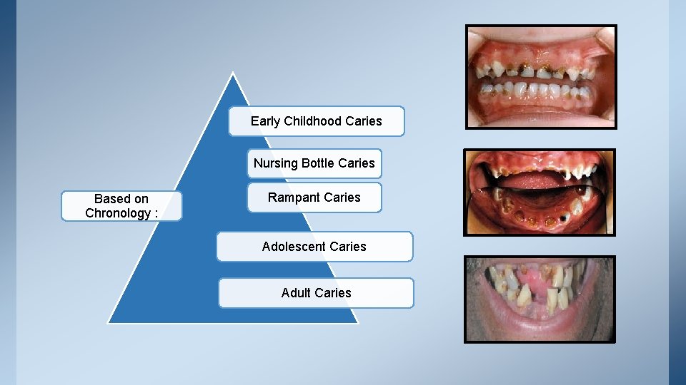 Early Childhood Caries Nursing Bottle Caries Based on Chronology : Rampant Caries Adolescent Caries