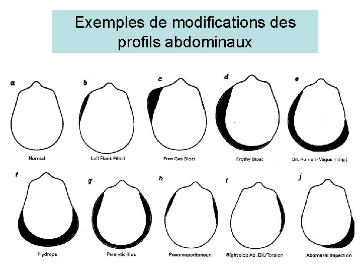 Exemples de modifications des profils abdominaux 