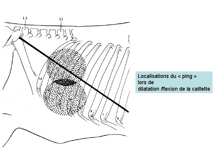 Localisations du « ping » lors de dilatation /flexion de la caillette 