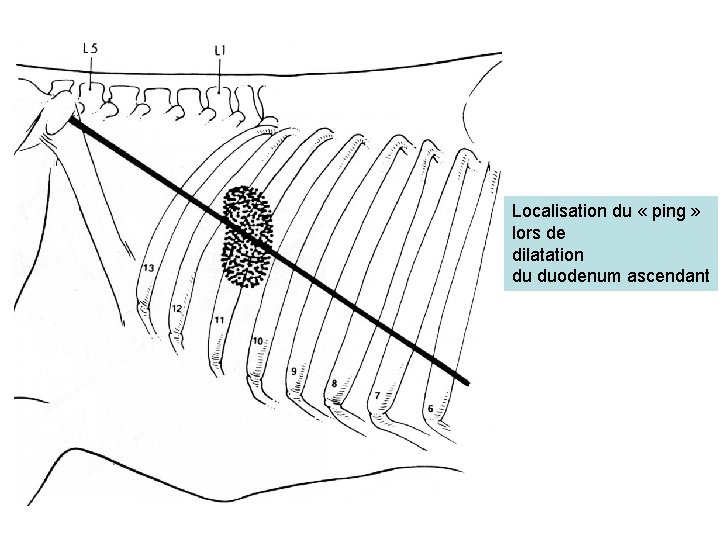 Localisation du « ping » lors de dilatation du duodenum ascendant 