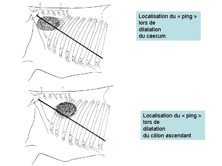 Localisation du « ping » lors de dilatation du caecum Localisation du « ping