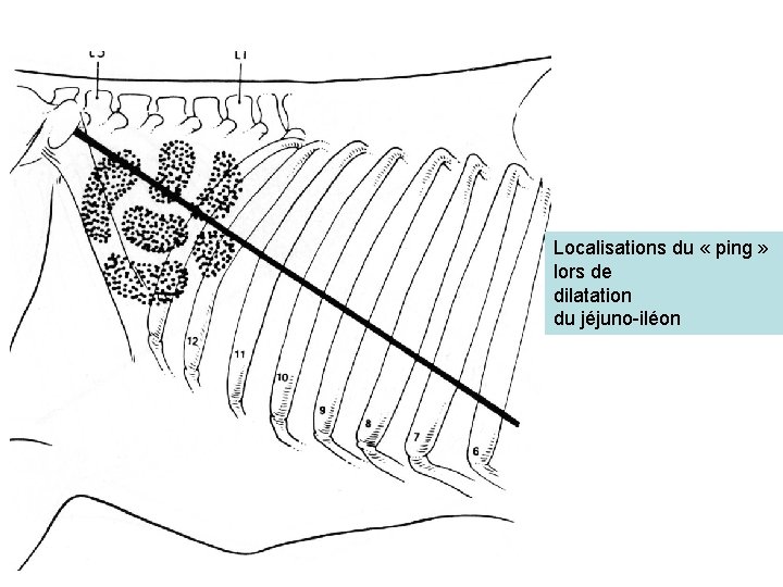 Localisations du « ping » lors de dilatation du jéjuno-iléon 