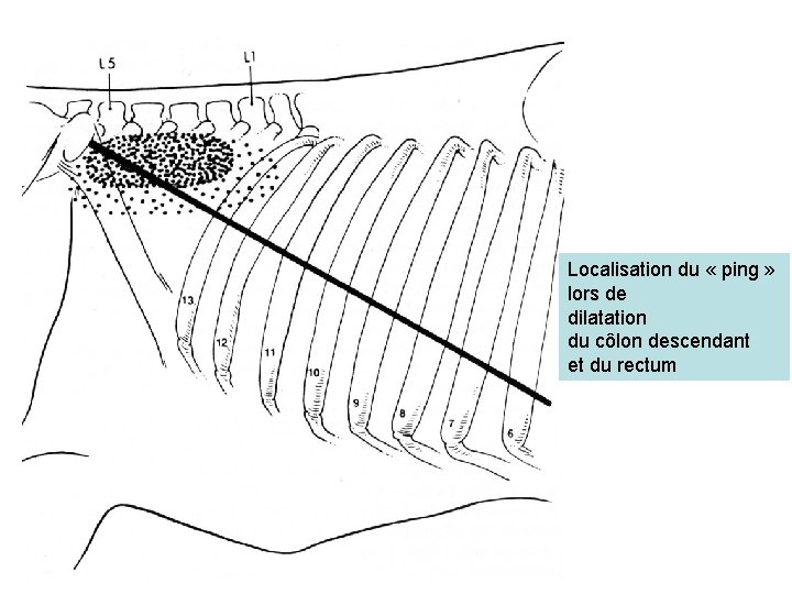 Localisation du « ping » lors de dilatation du côlon descendant et du rectum