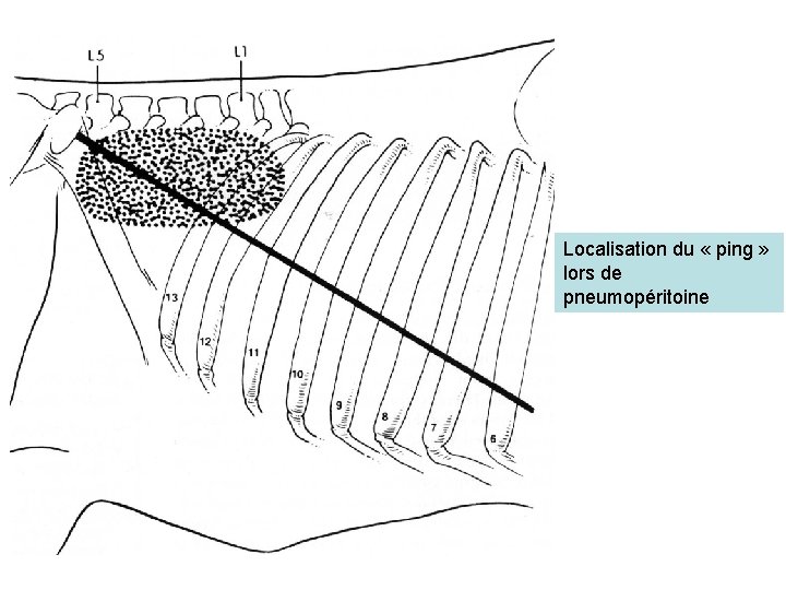 Localisation du « ping » lors de pneumopéritoine 