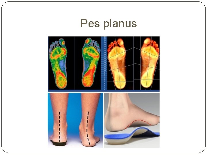 Pes planus 