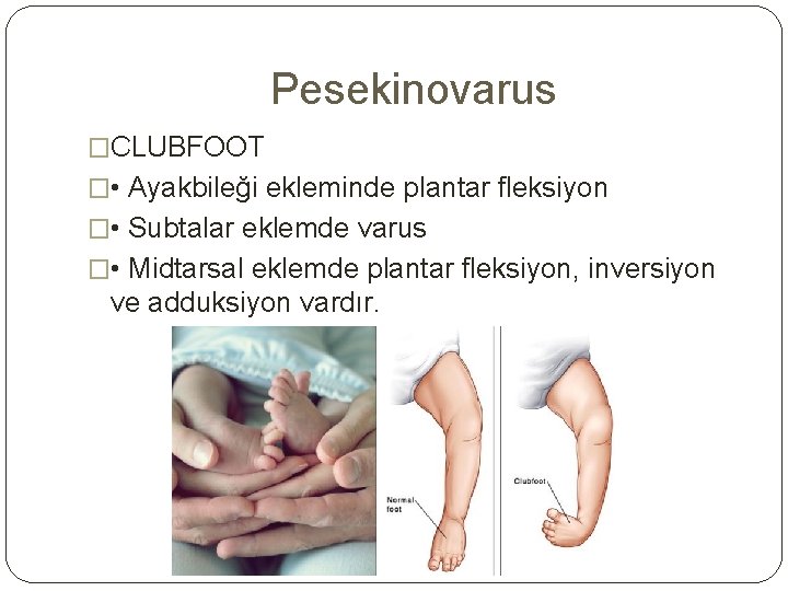 Pesekinovarus �CLUBFOOT � • Ayakbileği ekleminde plantar fleksiyon � • Subtalar eklemde varus �