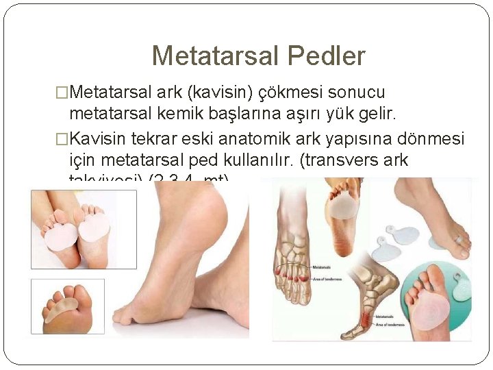 Metatarsal Pedler �Metatarsal ark (kavisin) çökmesi sonucu metatarsal kemik başlarına aşırı yük gelir. �Kavisin