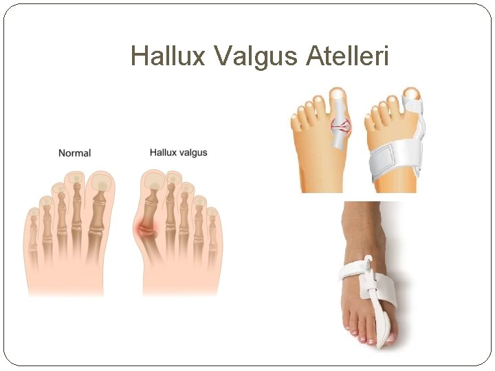 Hallux Valgus Atelleri 