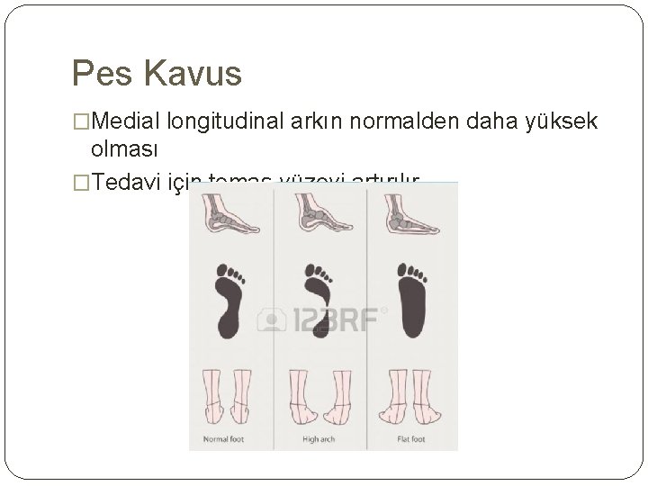 Pes Kavus �Medial longitudinal arkın normalden daha yüksek olması �Tedavi için temas yüzeyi artırılır
