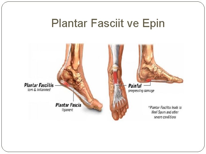 Plantar Fasciit ve Epin 