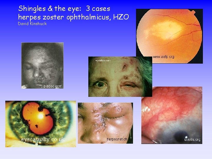 Shingles & the eye: 3 cases herpes zoster ophthalmicus, HZO David Kinshuck 