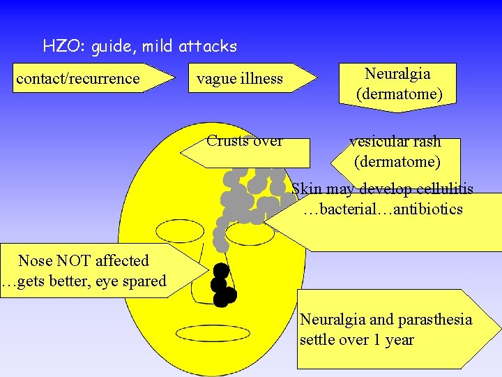 HZO: guide, mild attacks contact/recurrence vague illness Neuralgia (dermatome) Crusts over vesicular rash (dermatome)