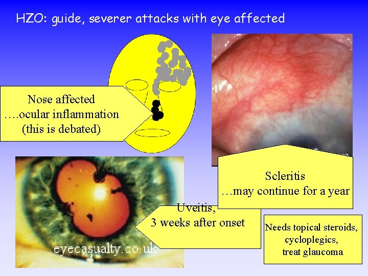 HZO: guide, severer attacks with eye affected Nose affected …. ocular inflammation (this is