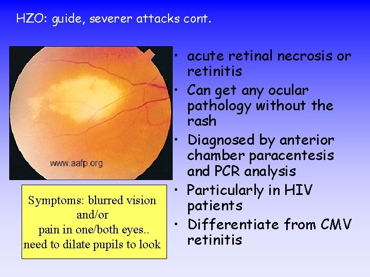 HZO: guide, severer attacks cont. • acute retinal necrosis or retinitis • Can get