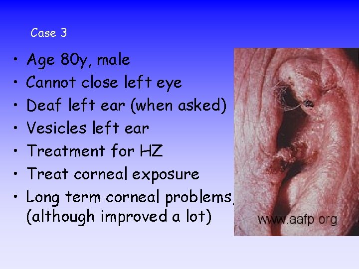 Case 3 • • Age 80 y, male Cannot close left eye Deaf left