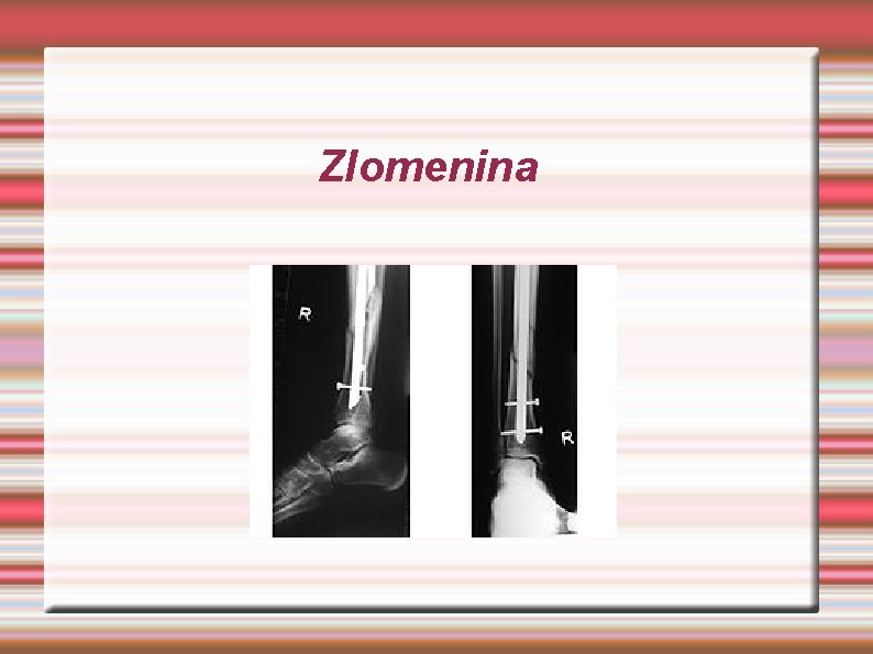 Zlomenina 