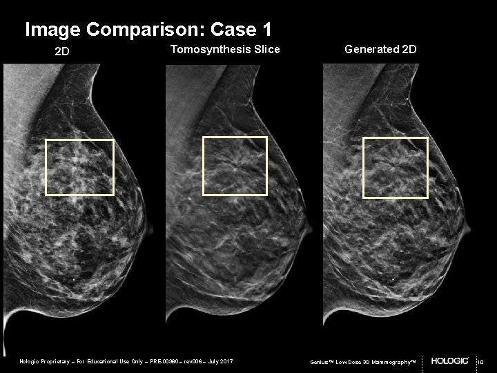 Image Comparison: Case 1 2 D Tomosynthesis Slice Hologic Proprietary – For Educational Use