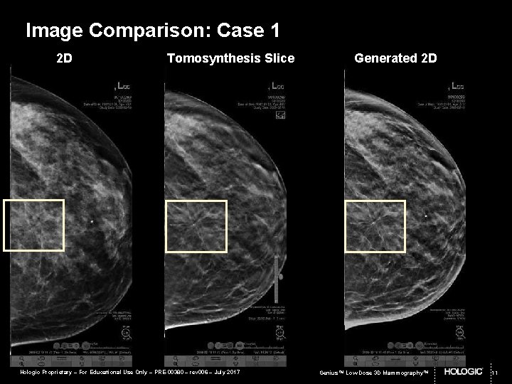Image Comparison: Case 1 2 D Tomosynthesis Slice Hologic Proprietary – For Educational Use