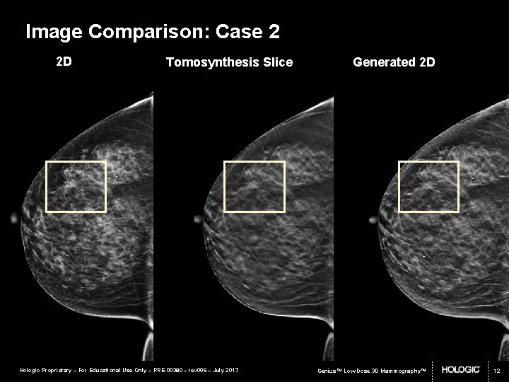 Image Comparison: Case 2 2 D Tomosynthesis Slice Hologic Proprietary – For Educational Use
