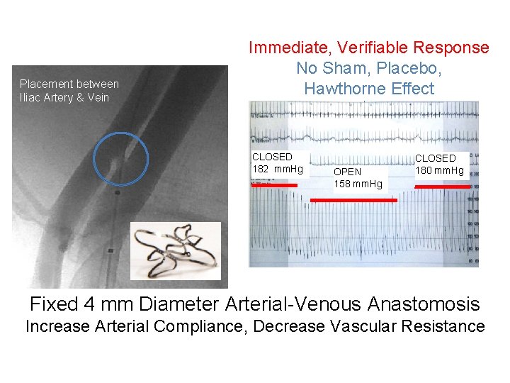 Placement between Iliac Artery & Vein Immediate, Verifiable Response No Sham, Placebo, Hawthorne Effect